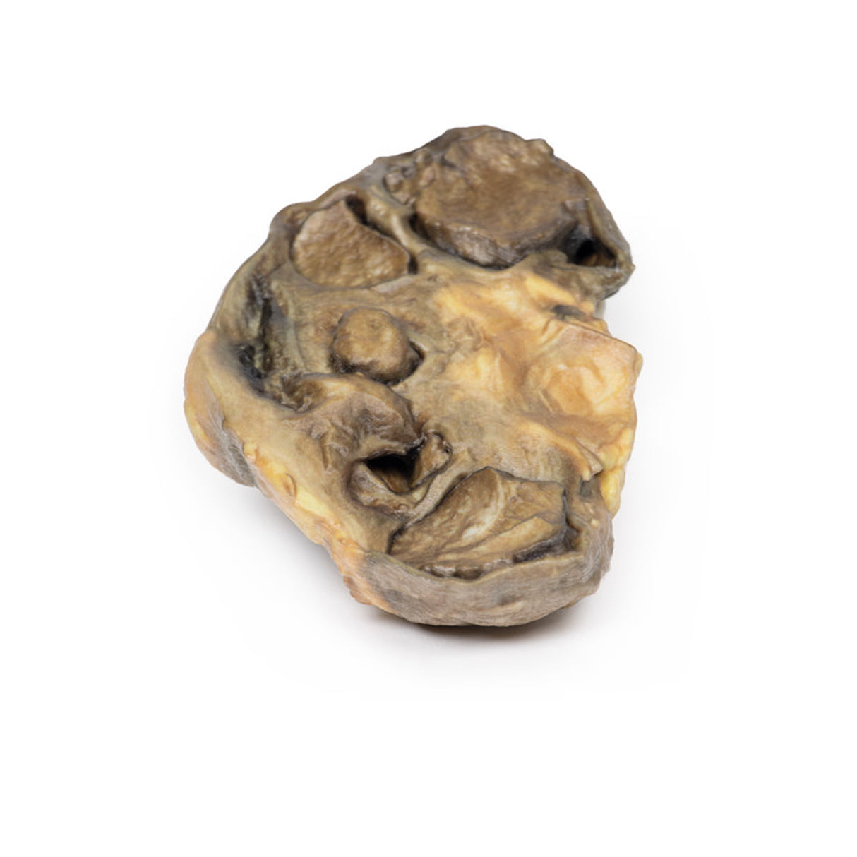 Pyonephrosis | EZ-MP2096 | Sim & Skills Ltd