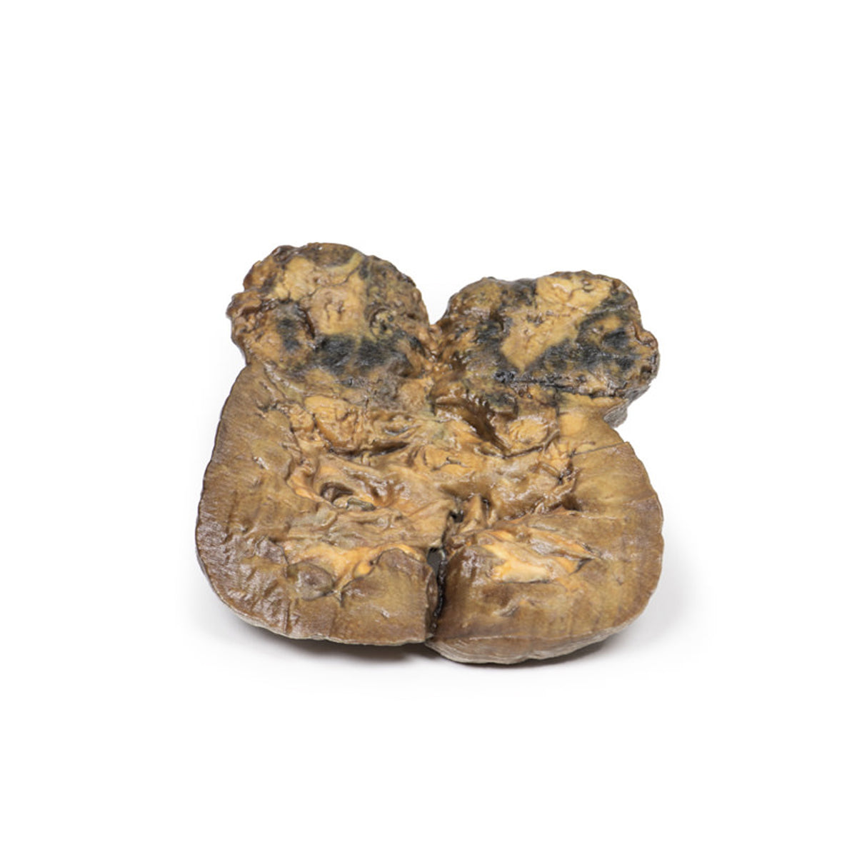 Renal Cell Carcinoma | EZ-MP2097 | Sim & Skills Ltd