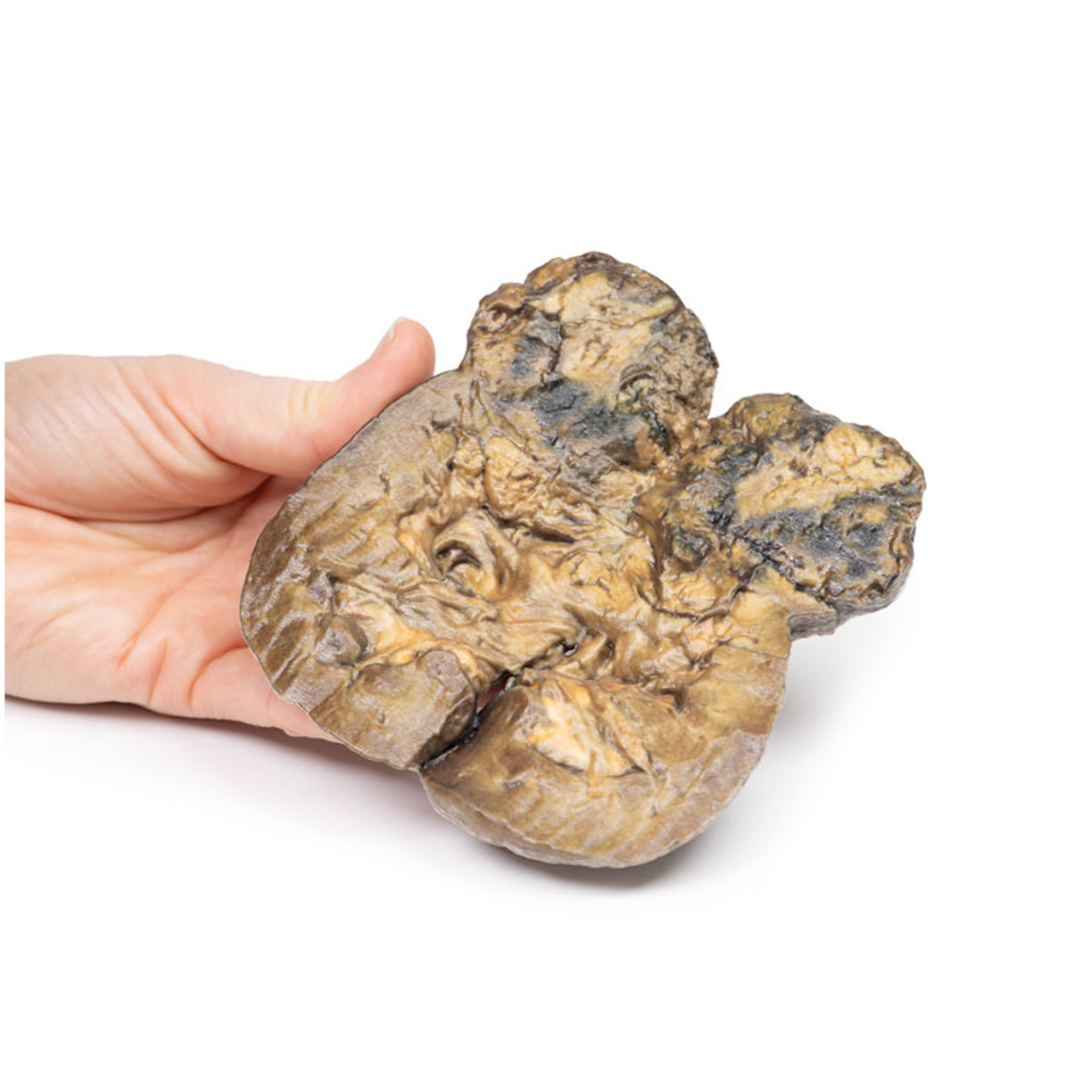 Renal Cell Carcinoma | EZ-MP2097 | Sim & Skills Ltd
