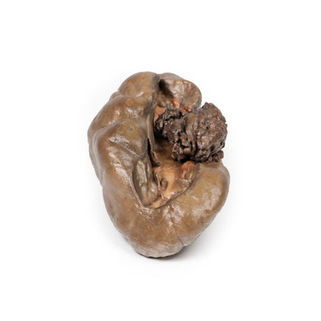 Papillary Transitional Cell Carcinoma of the Renal Pelvis | EZ-MP2099 | Sim & Skills Ltd
