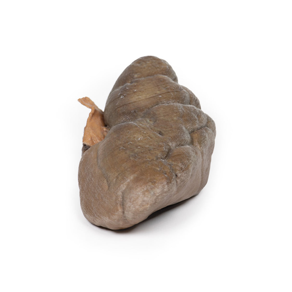 Papillary Transitional Cell Carcinoma of the Renal Pelvis | EZ-MP2099 | Sim & Skills Ltd