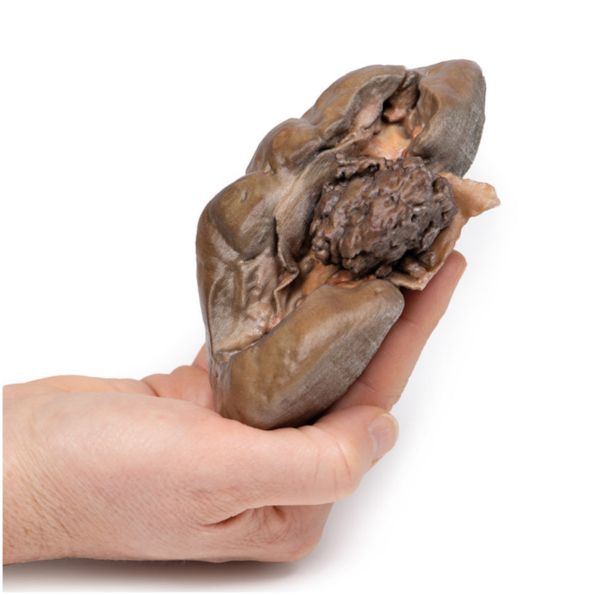 Papillary Transitional Cell Carcinoma of the Renal Pelvis | EZ-MP2099 | Sim & Skills Ltd