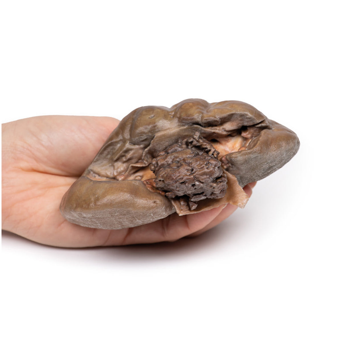 Papillary Transitional Cell Carcinoma of the Renal Pelvis | EZ-MP2099 | Sim & Skills Ltd