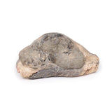 Carcinoma of Breast | EZ-MP2105 | Sim & Skills Ltd