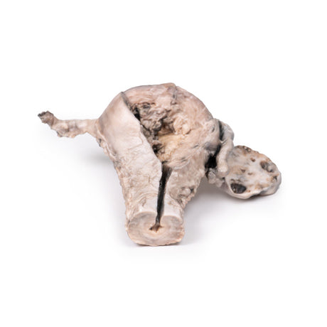 Endometrial Carcinoma | EZ-MP2106 | Sim & Skills Ltd