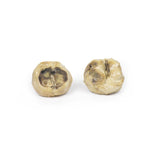 Nodular hyperplasia of the Prostate | EZ-MP2108 | Sim & Skills Ltd