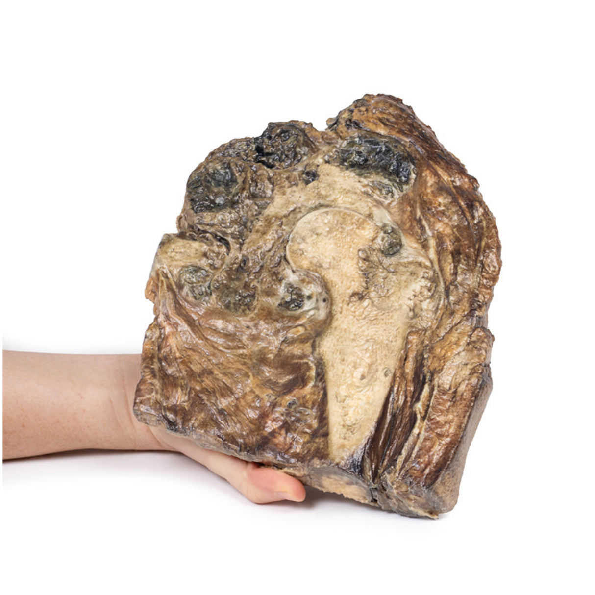 Chondrosarcoma of femur and ilium | EZ-MP2112 | Sim & Skills Ltd