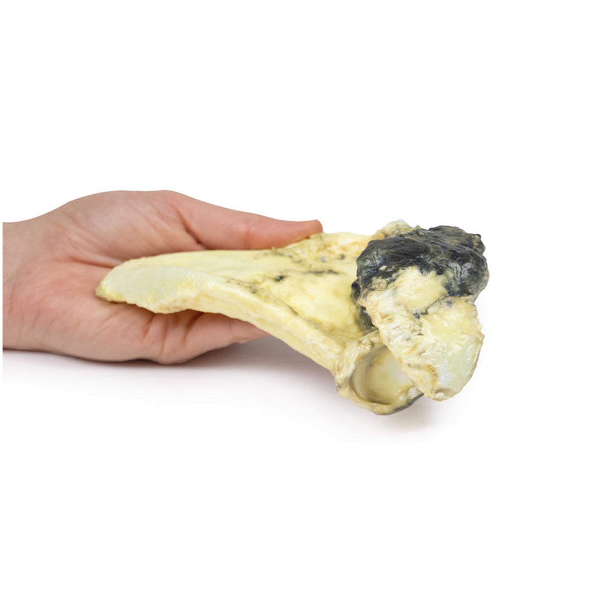 Chondrosarcoma of scapula | EZ-MP2114 | Sim & Skills Ltd