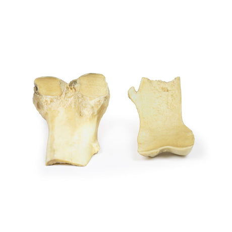 Osteochondroma | EZ-MP2118 | Sim & Skills Ltd