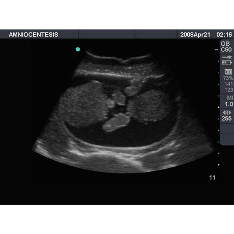 Amniocentesis Ultrasound Training Model BP1610 | Sim & Skills