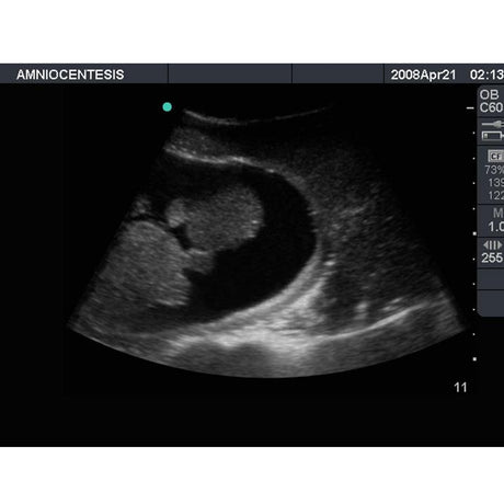 Amniocentesis Ultrasound Training Model BP1610 | Sim & Skills