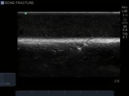 Bone Fracture Ultrasound Training Block Model BPBF200-C | Sim & Skills