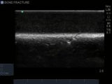 Bone Fracture Ultrasound Training Block Model BPBF200-C | Sim & Skills