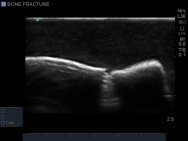 Bone Fracture Ultrasound Training Block Model BPBF200-C | Sim & Skills