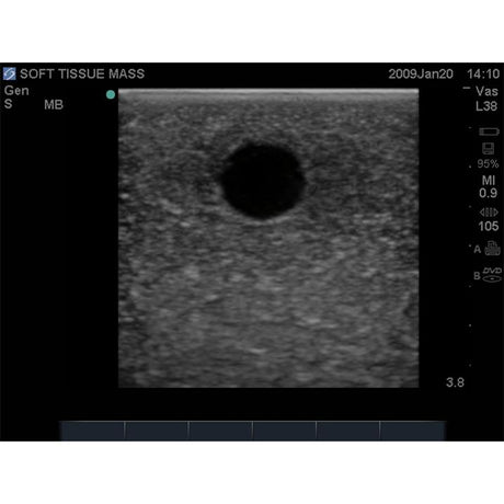 Breast Biopsy Ultrasound Training Model BPB170 | Sim & Skills