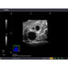 Combination IUP Ectopic Pregnancy Transvaginal Ultrasound Training Model BPOB1227 | Sim & Skills