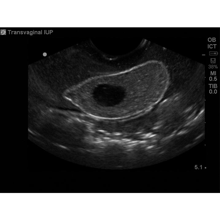 Combination IUP Ectopic Pregnancy Transvaginal Ultrasound Training Model BPOB1227 | Sim & Skills