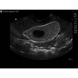 Combination IUP Ectopic Pregnancy Transvaginal Ultrasound Training Model BPOB1227 | Sim & Skills