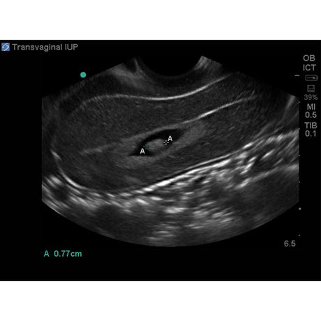 Combination IUP Ectopic Pregnancy Transvaginal Ultrasound Training Model BPOB1227 | Sim & Skills