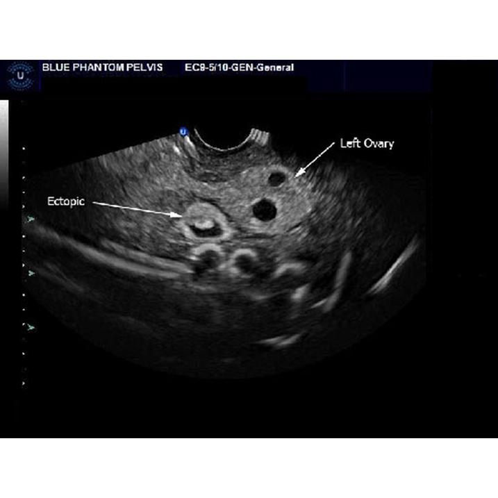 Combination IUP Ectopic Pregnancy Transvaginal Ultrasound Training Model BPOB1227 | Sim & Skills