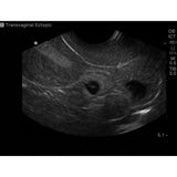 Combination IUP Ectopic Pregnancy Transvaginal Ultrasound Training Model BPOB1227 | Sim & Skills