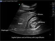 FAST, TTE and Pericardiocentesis Ultrasound Training Model BP-FAST1800 | Sim & Skills