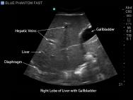 FAST, TTE and Pericardiocentesis Ultrasound Training Model BP-FAST1800 | Sim & Skills