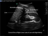 FAST, TTE and Pericardiocentesis Ultrasound Training Model BP-FAST1800 | Sim & Skills