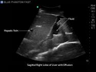 FAST, TTE and Pericardiocentesis Ultrasound Training Model BP-FAST1800 | Sim & Skills