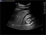 FAST, TTE and Pericardiocentesis Ultrasound Training Model BP-FAST1800 | Sim & Skills