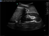 FAST, TTE and Pericardiocentesis Ultrasound Training Model BP-FAST1800 | Sim & Skills