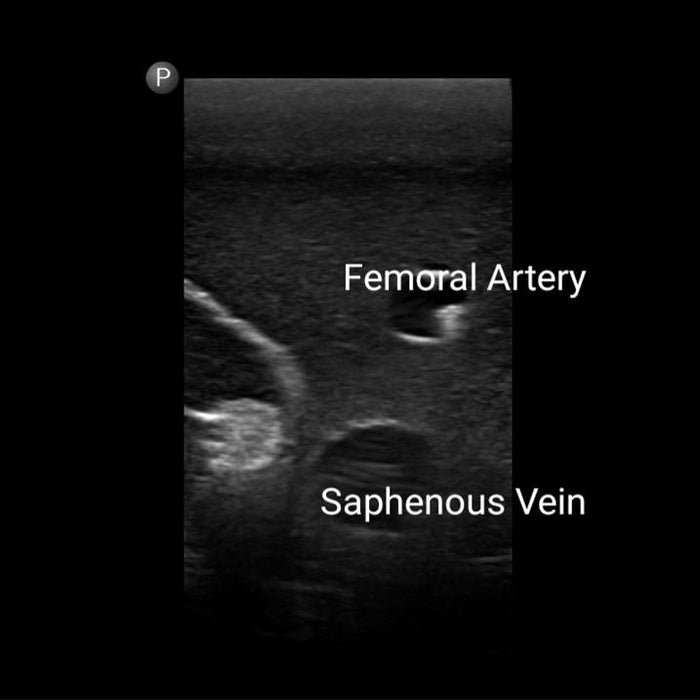 Gen II Femoral Vascular Access and Regional Anaesthesia Ultrasound ...
