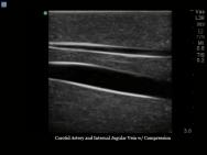 Gen II Regional Anaesthesia and Central Line Ultrasound Training Model BPHNB670-HP | Sim & Skills