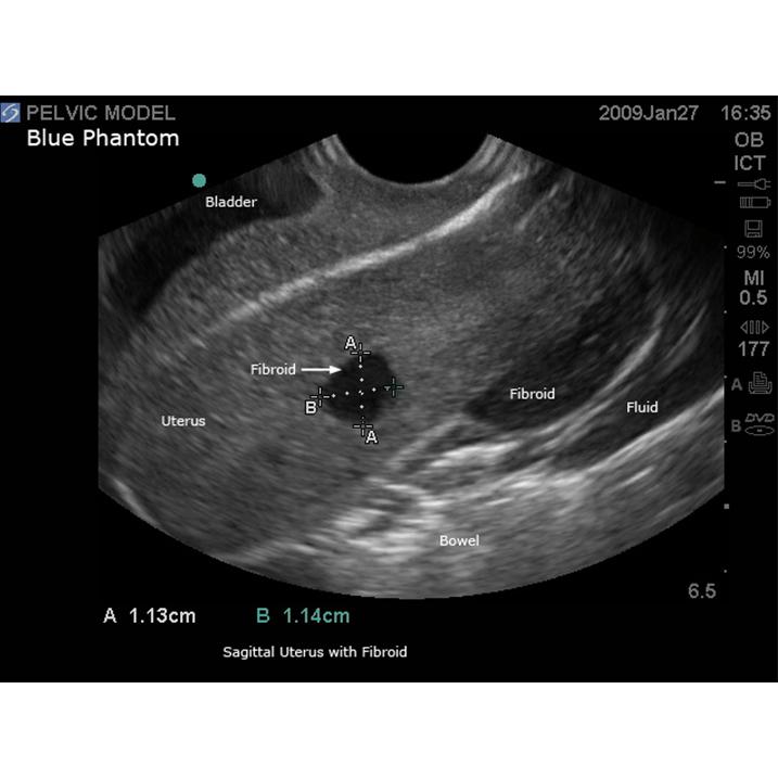 General Pathology Transvaginal Ultrasound Training Model BPOB1220 | Sim & Skills