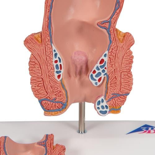 Haemorrhoid Model - 3B Smart Anatomy 1000315 | Sim & Skills