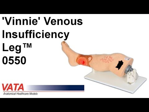 Vinnie Venous Insufficiency Leg