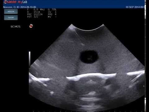 Abscess Drainage Ultrasound Training Model