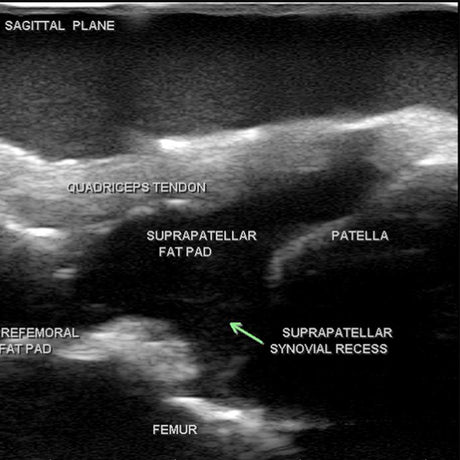 Knee Aspiration & Injection Ultrasound Training Model BPMSK-1000 | Sim & Skills