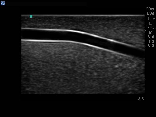 Leg Femoral and Saphenous Vein Venous Access Ultrasound Training Model with DVT Option BPL400 | Sim & Skills