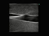 Leg Femoral and Saphenous Vein Venous Access Ultrasound Training Model with DVT Option BPL400 | Sim & Skills