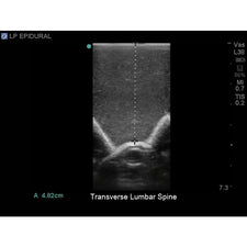 Lumbar Puncture and Spinal Epidural Ultrasound Training Model - Sim ...