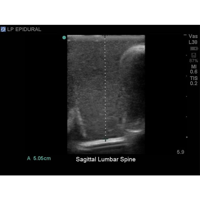 Lumbar Puncture and Spinal Epidural Ultrasound Training Model BPLP2101 | Sim & Skills