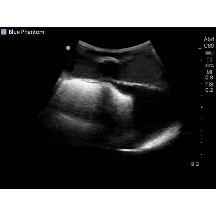 Midscapular Thoracentesis Ultrasound Training Model BPTT2-1005 | Sim & Skills