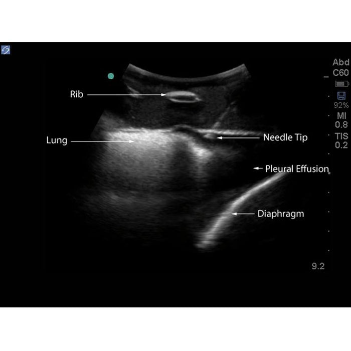Midscapular Thoracentesis Ultrasound Training Model BPTT2-1005 | Sim & Skills