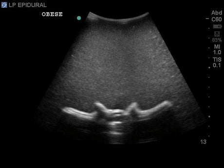 Obese Lumbar Epidural and Lumbar Puncture Replacement Tissue BPLP2204 | Sim & Skills