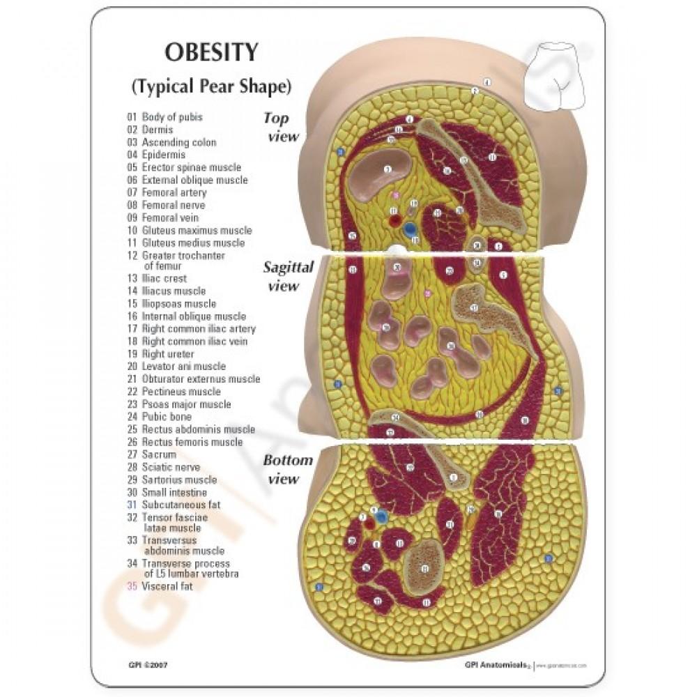 Obesity Model for Nutrition and Weight Loss Education 1019566 | Sim & Skills