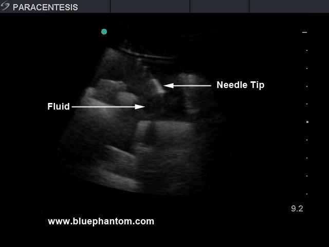 Paracentesis Ultrasound Replacement Tissue Insert BPPara1302 | Sim & Skills