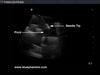 Paracentesis Ultrasound Replacement Tissue Insert BPPara1302 | Sim & Skills