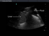 Paracentesis Ultrasound Replacement Tissue Insert BPPara1302 | Sim & Skills