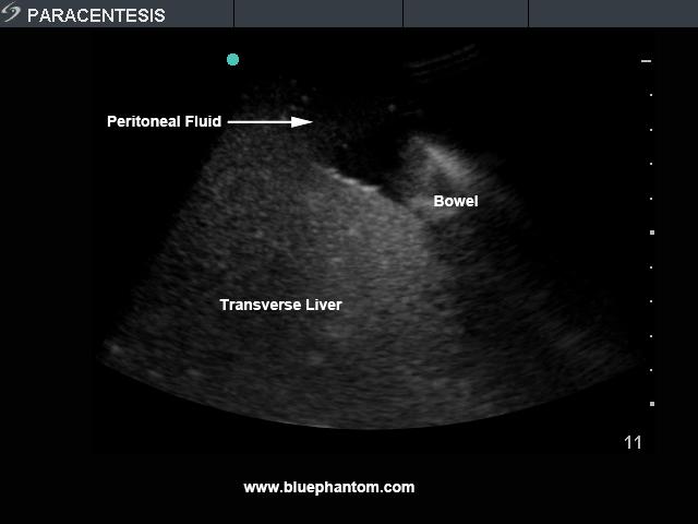 Paracentesis Ultrasound Replacement Tissue Insert BPPara1302 | Sim & Skills